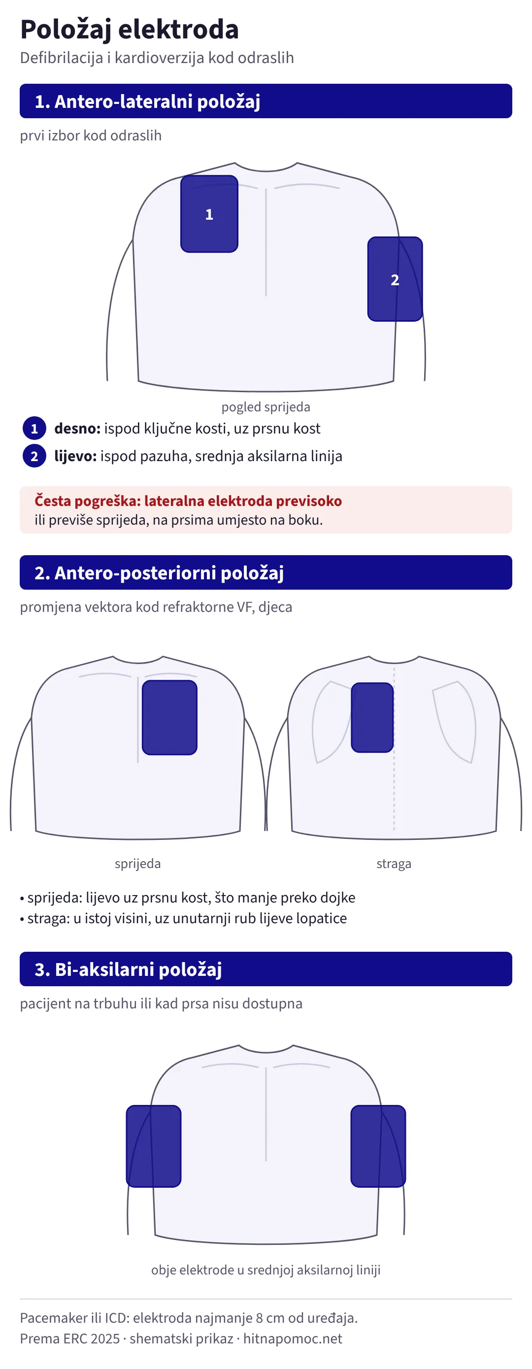 Tri položaja elektroda. Antero-lateralni: jedna elektroda desno ispod ključne kosti uz prsnu kost, druga lijevo ispod pazuha u srednjoj aksilarnoj liniji. Antero-posteriorni: sprijeda lijevo uz prsnu kost, straga u istoj visini uz unutarnji rub lijeve lopatice. Bi-aksilarni: obje elektrode na bočnim stranama prsnog koša u srednjoj aksilarnoj liniji.