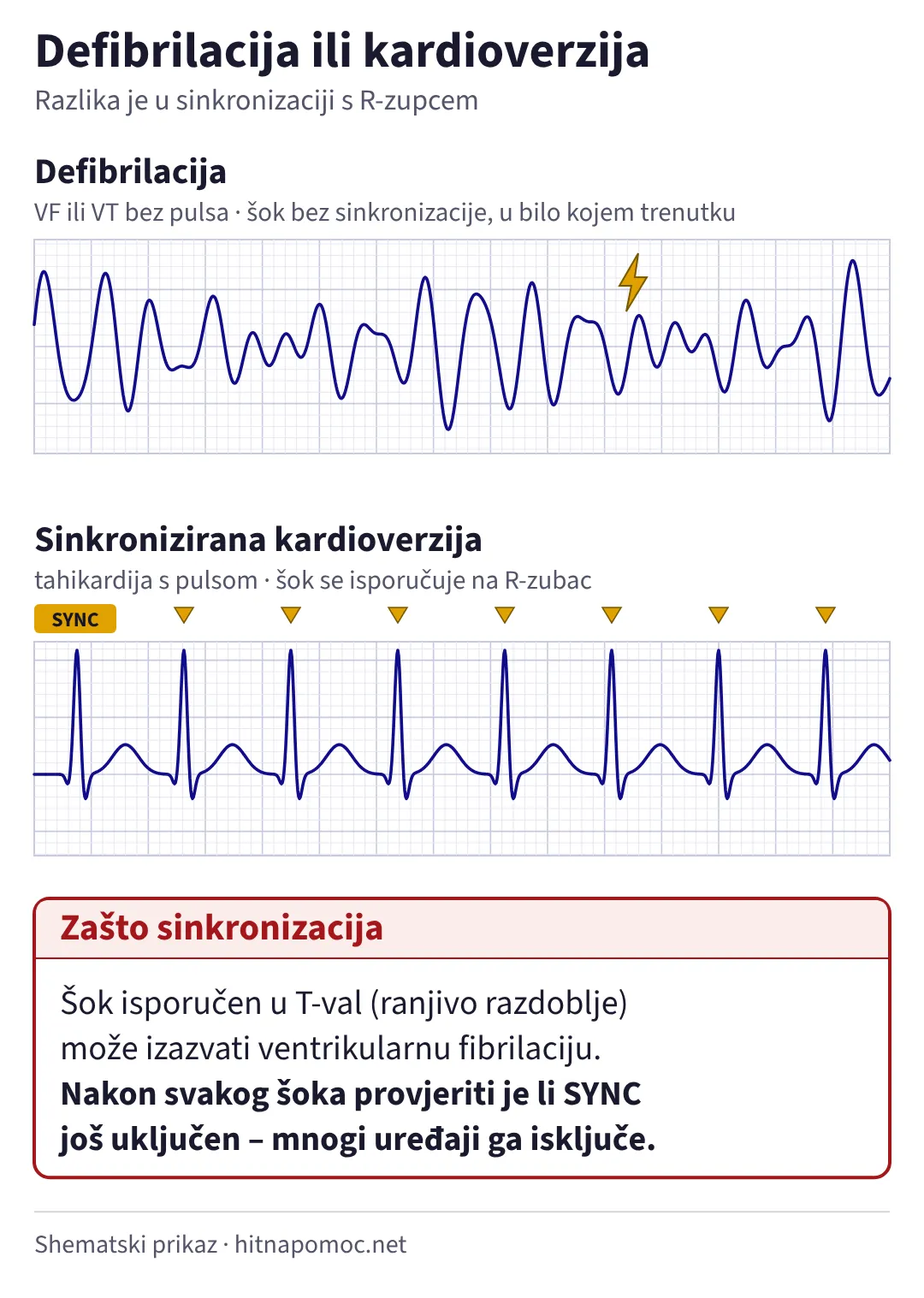 Usporedba defibrilacije i sinkronizirane kardioverzije. Kod ventrikularne fibrilacije šok se isporučuje bez sinkronizacije u bilo kojem trenutku. Kod tahikardije s pulsom uključen je SYNC, a oznake iznad svakog R-zupca pokazuju da će šok biti isporučen na R-zubac. Šok u T-val može izazvati ventrikularnu fibrilaciju, pa nakon svakog šoka treba provjeriti je li SYNC još uključen.