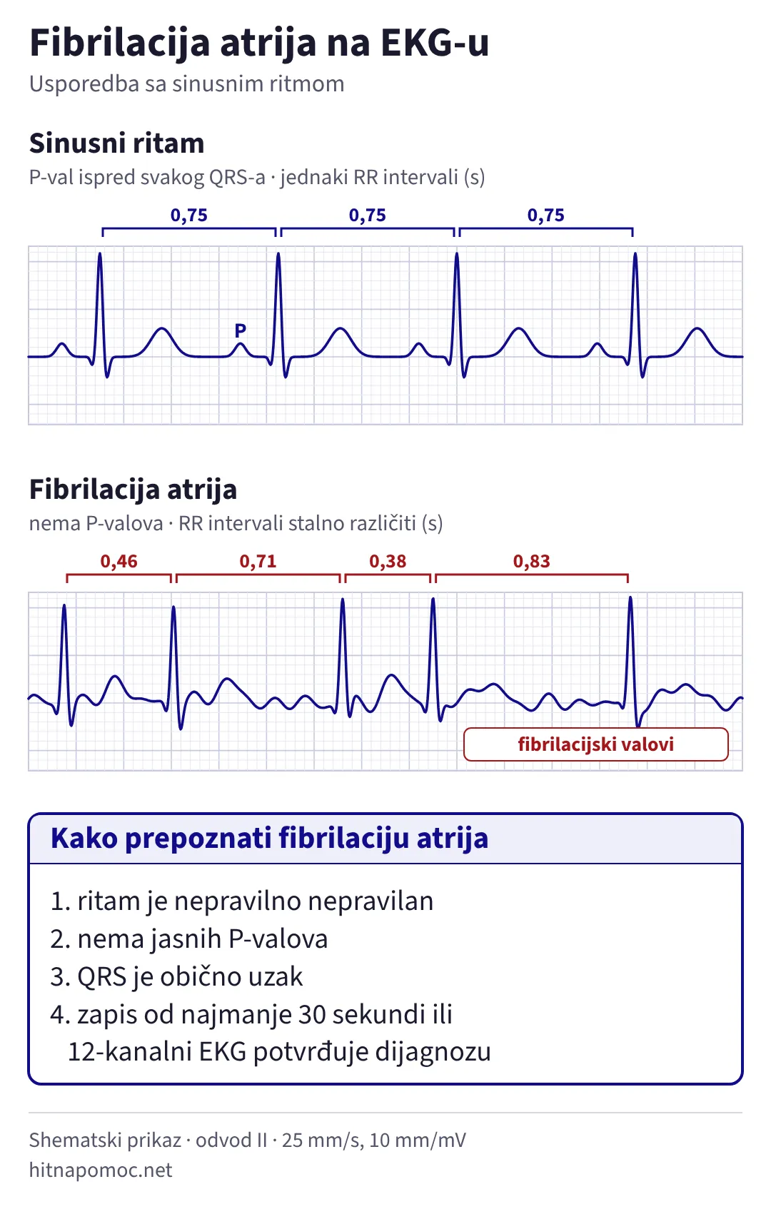 Usporedba sinusnog ritma i fibrilacije atrija. Kod sinusnog ritma ispred svakog QRS-a je P-val, a svi RR intervali iznose 0,75 s. Kod fibrilacije atrija nema P-valova, izoelektrična linija je valovita, a RR intervali su 0,46, 0,71, 0,38 i 0,83 s.