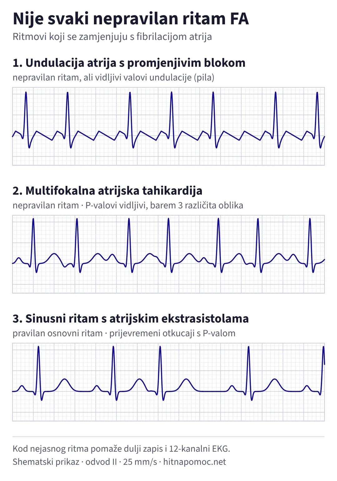 Tri ritma koji se zamjenjuju s fibrilacijom atrija: undulacija atrija s promjenjivim blokom i vidljivim valovima u obliku pile, multifokalna atrijska tahikardija s P-valovima različitog oblika te sinusni ritam s prijevremenim atrijskim ekstrasistolama.