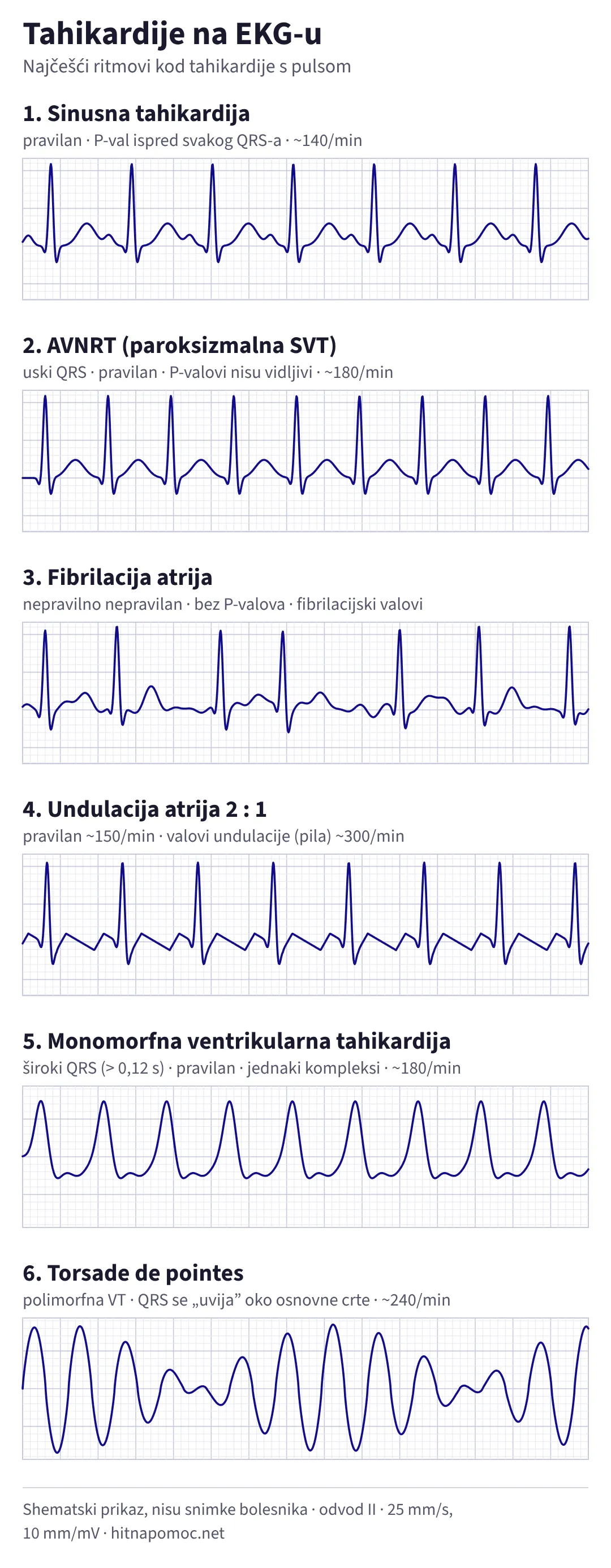 Šest shematskih EKG traka: sinusna tahikardija s P-valom ispred svakog QRS-a, AVNRT s uskim pravilnim QRS-om bez vidljivih P-valova, fibrilacija atrija s nepravilnim ritmom bez P-valova, undulacija atrija 2 : 1 s valovima u obliku pile, monomorfna ventrikularna tahikardija sa širokim jednakim kompleksima i torsade de pointes s kompleksima koji mijenjaju amplitudu i smjer oko osnovne crte.